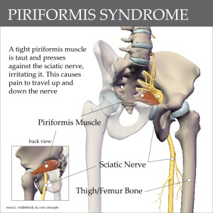 Piriformis Syndrome – Sciatica _ Singapore Physio